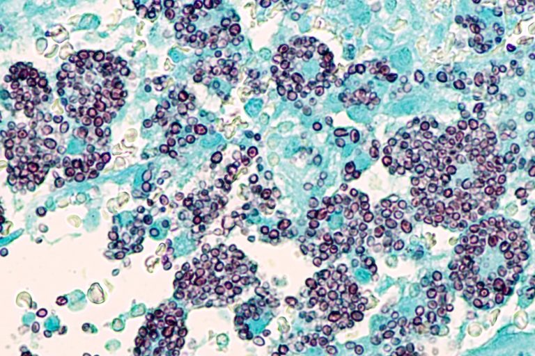 NIOSH Looks to Raise Awareness of Fungal Infection Histoplasmosis in